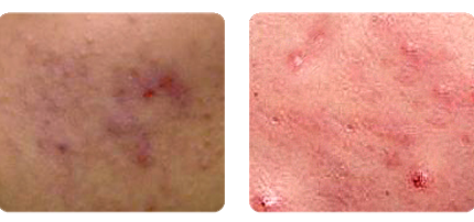 acne skin Problem