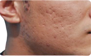 acne scarring problem