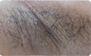 unwanted hair growth problem